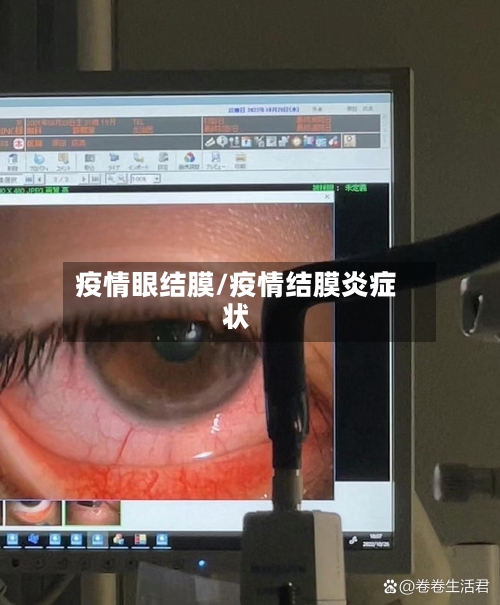 疫情眼结膜/疫情结膜炎症状-第1张图片