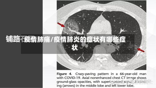 疫情肺痛/疫情肺炎的症状有哪些症状-第2张图片